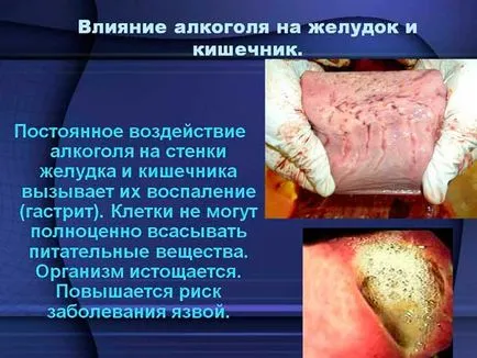 Стомашни болки след употреба на алкохол - отколкото да се лекува и как да се възстанови