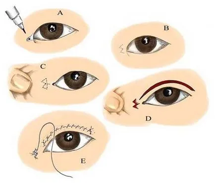 ochi din Asia Blefaroplastia (plastic) - Poze inainte si dupa, comentarii, după corectare, pret