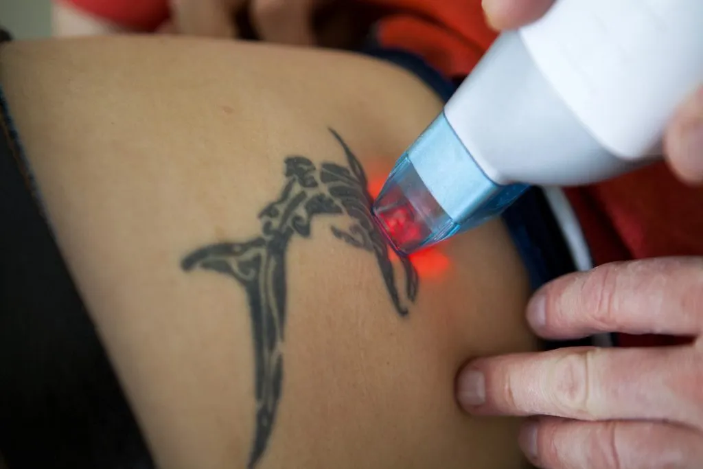 Rata de eliminare laser tatuaj