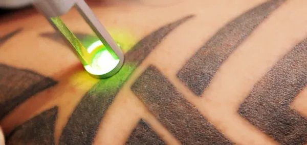 Rata de eliminare laser tatuaj