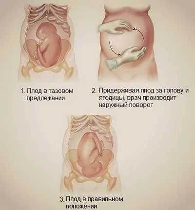 Какво прави седалищно предлежание представяне на плода, и двете са на труда