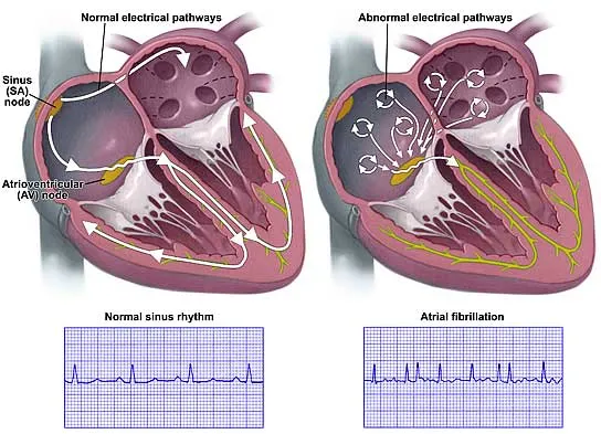 Mi lehet a miokardiális infarktus után