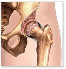 Boli degenerative articulare leziuni osteoartritei