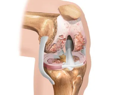 Boli degenerative articulare leziuni osteoartritei