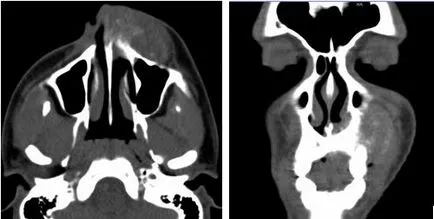 Valoarea Cldh tomografie computerizata in diagnosticul formațiunilor vrac doverifikatsionnoy