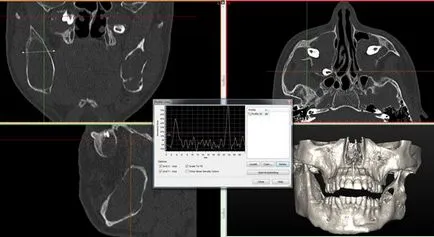 Cldh стойност компютърна томография при диагностициране на насипни формации doverifikatsionnoy