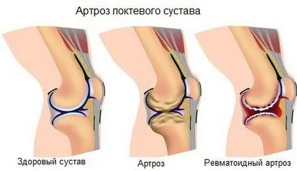 Boli degenerative articulare leziuni osteoartritei