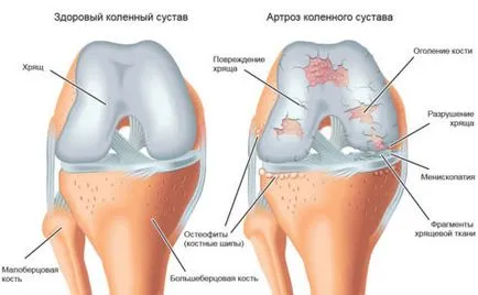 Degeneratív-disztrófiás betegségek az ízületek részletesen a közös patológiák