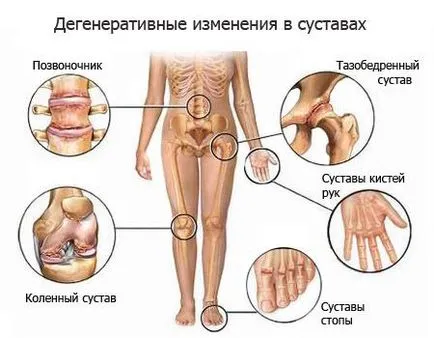 Boli degenerative articulare leziuni osteoartritei