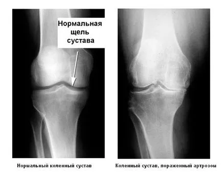 Degeneratív ízületi betegség osteoarthritis kár