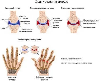 Boli degenerative articulare leziuni osteoartritei