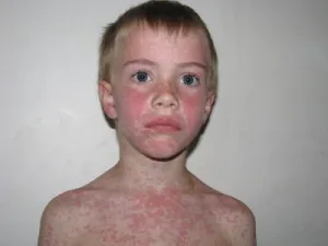 A gyermekkori betegségek kiütések a bőrön