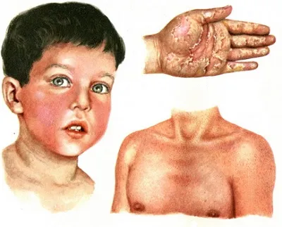 детски болести с обрива за възпалено гърло, скарлатина, рубеола при