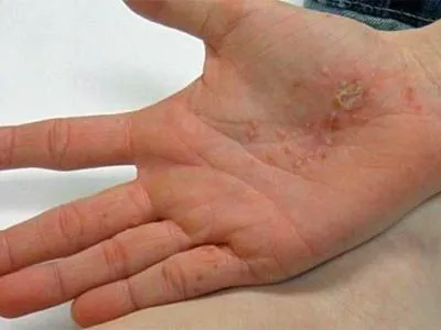 Дісгідротіческая екзема і як її вилікувати народними засобами