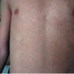 Причини і симптоми мелкоточечная кератоліз, методи лікування (кератоліз) Причини і симптоми мелкоточечная кератоліз, методи лікування