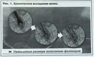 Застосування лосьйону неоптід при хронічному випаданні волосся у жінок