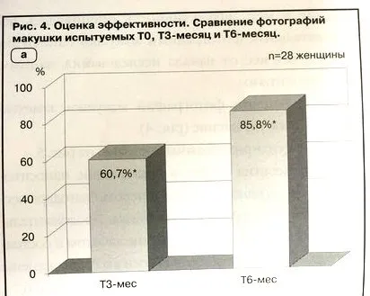 Застосування лосьйону неоптід при хронічному випаданні волосся у жінок