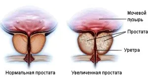 prostata Fibroza cauze, simptome, tratamentul sclerozei prostatei