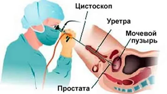 prosztata fibrózis okok, tünetek, kezelés a prosztata sclerosis