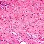 Ganglioneyroblastoma - симптоми, диагностика, лечение, прогноза