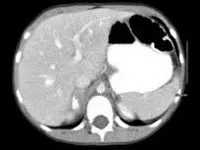 Ganglioneyroblastoma - причини, симптоми, диагностика и лечение