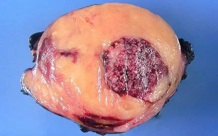 Ganglioneyroblastoma - simptome, diagnostic, tratament, prognostic