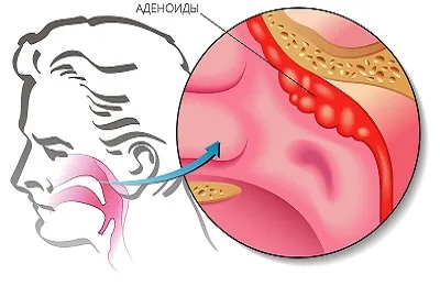 Adenoid megnagyobbodás grade 2 és 3 gyermek is