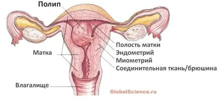 Гинеколог онколог предложих гинекологични полипи