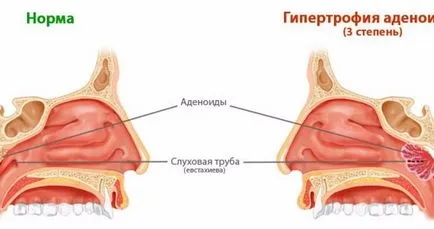 Cauzele hipertrofia adenoide, măsură, simptome și tratament