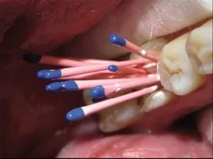 Гутаперча в стоматологията - това, което е напълването на коренови канала щифтове