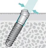 implantátumok Ankylos