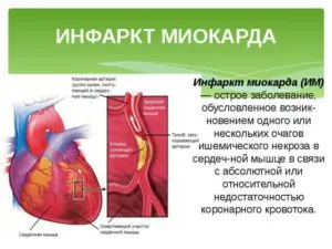 infarct măduvei spinării în infarctul miocardic