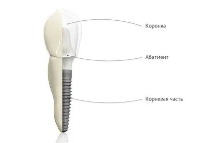 Імплантанти зубів (варто імплантація одного зуба) імплантанти зубів