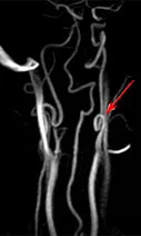 accident vascular cerebral ischemic la VBB, portalul radiologi