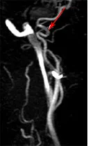 Ischaemiás stroke VBB radiológusok portál