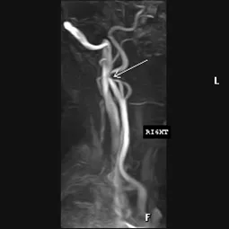 accident vascular cerebral ischemic la VBB, portalul radiologi