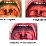 Профілактика ангіни у дорослих і дітей як уникнути (профілактика ангіни дорослих) Профілактика ангіни у дорослих і дітей як уникнути