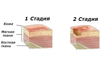 Пролежні на сідницях ніж лікувати і як позбутися в домашніх умовах (сідницях) Пролежні на сідницях ніж лікувати і як позбутися в домашніх умовах