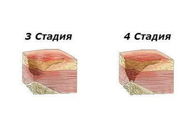 Пролежні на сідницях ніж лікувати і як позбутися в домашніх умовах (сідницях) Пролежні на сідницях ніж лікувати і як позбутися в домашніх умовах
