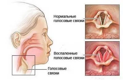 Пропав голос і болить горло як і чим лікувати, і які причини (лікувати) Пропав голос і болить горло як і чим лікувати, і які причини