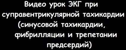 Ознаки тріпотіння передсердь на ЕКГ (має пилкоподібну форму) Ознаки тріпотіння передсердь на ЕКГ