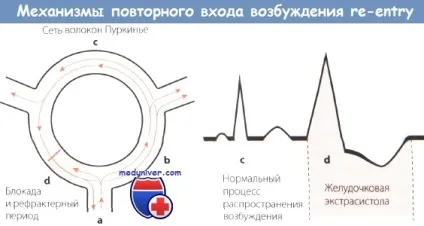 Ознаки тріпотіння передсердь на ЕКГ (передсердь) Ознаки тріпотіння передсердь на ЕКГ