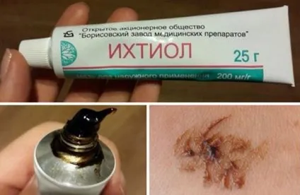 Прищі на спині у підлітка - плечах, дівчатка і хлопчики, причини, лікування, що робити - живи здорово