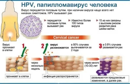 Щеплення від папіломи (вакцина) - проти вірусу, людини, за і проти, ціна, відгуки, раку шийки (вакцина) Щеплення від папіломи (вакцина) - проти вірусу, людини, за і проти, ціна, відгуки, раку шийки