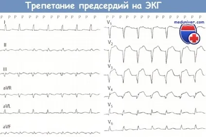 Ознаки тріпотіння передсердь на ЕКГ (тріпотіння) Ознаки тріпотіння передсердь на ЕКГ