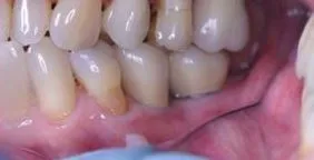 Care sunt coroanele pe dinti, dentare tipuri de coroane - fotografii, preturi