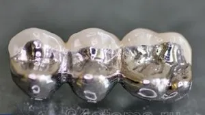 Care sunt coroanele pe dinti, dentare tipuri de coroane - fotografii, preturi