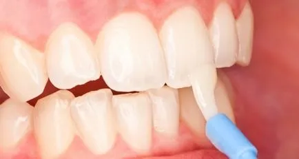 Какви са без кариозни лезии на зъбите