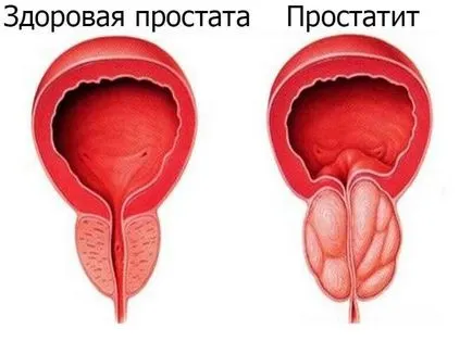 Какви са симптомите на простатит и как да се предпазите от него