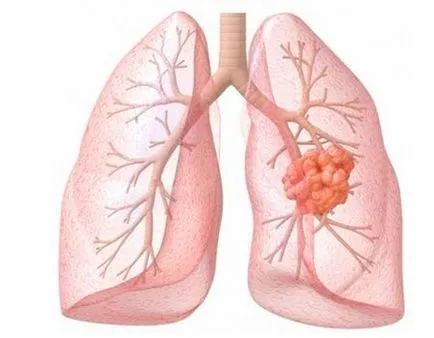 Hogyan kell kezelni obstruktív bronchitis otthon